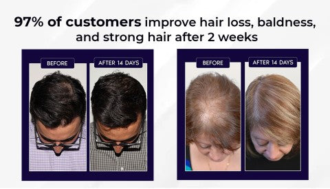 đż HZA⢠Natural Hair Regrowth Spray â 70% OFF Ends Tonight!
