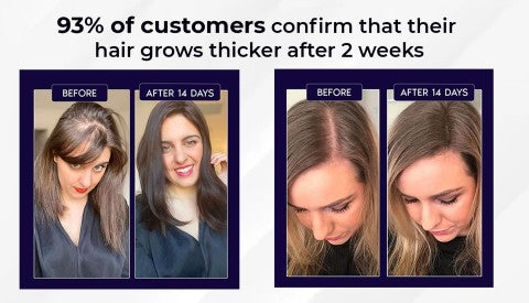 đż HZA⢠Natural Hair Regrowth Spray â 70% OFF Ends Tonight!